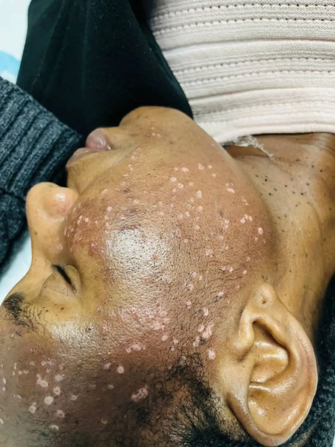 Skin treatment
