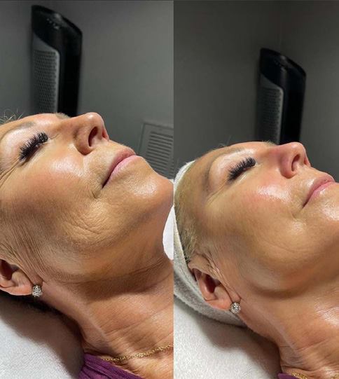 Before and after result of a clinical skin treatment