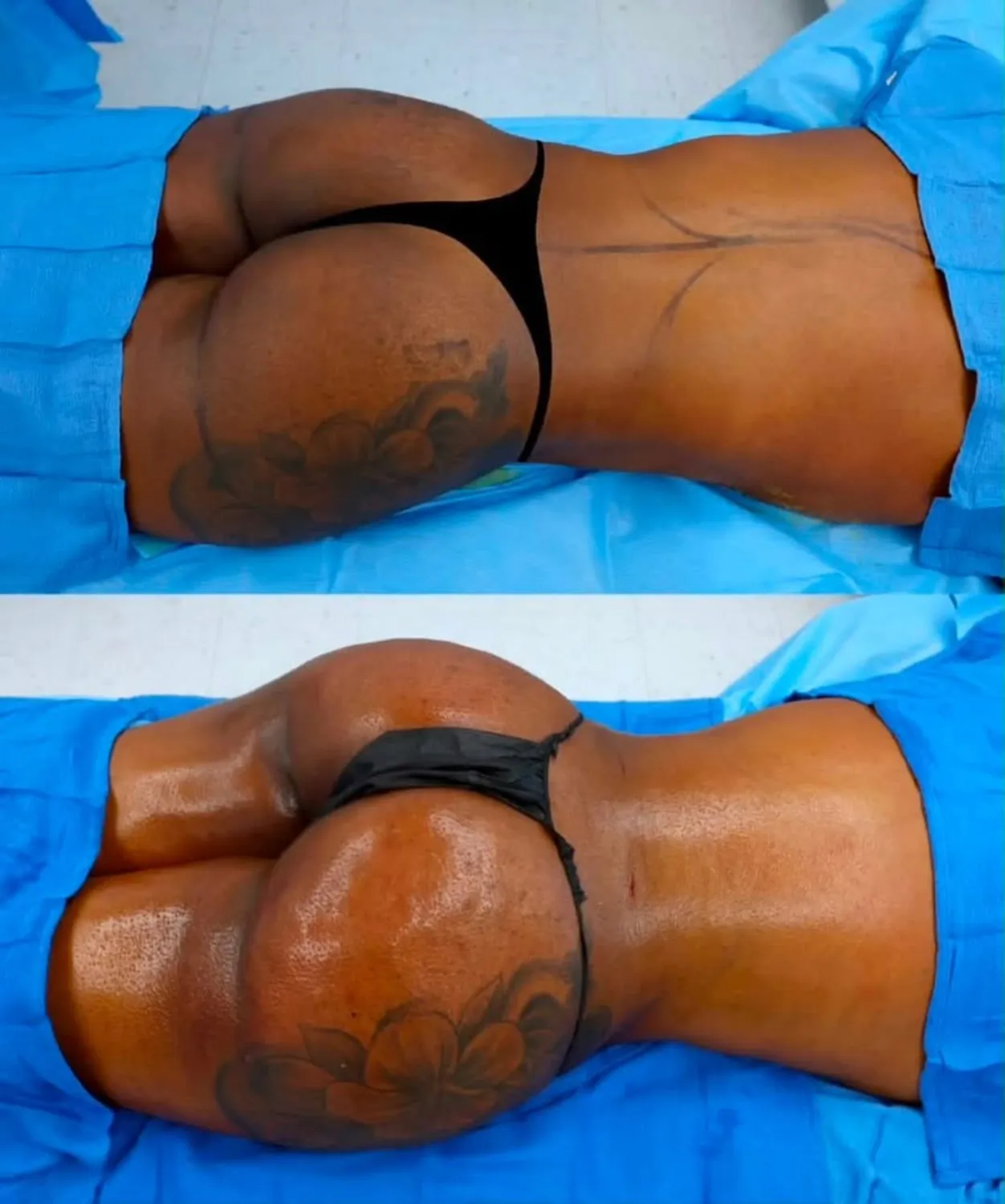 Centre-supplied before and after photographs illustrating a body-contouring result
